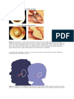 Figure 2. Comparison of Otitis Media With Effusion (Top) and Acute Otitis Media (Bottom) - The Left