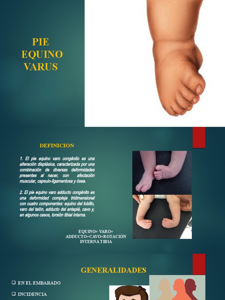 Clasificación de Pirani en Pie Equino Varus | PDF | Pie | Enfermedades ...