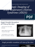 Gambaran Radiologi Pada ARDS