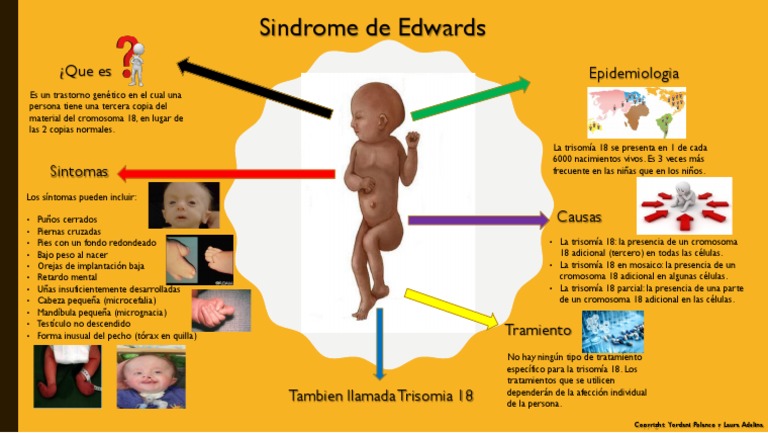 INFOGRAFIA Sindrome de Edwards | PDF | Medicina CLINICA | Enfermedades ...