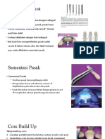 Fiber Post Dowel Crown