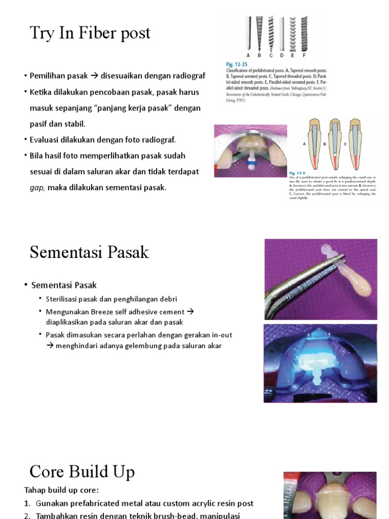 Fiber Post Dowel Crown PDF