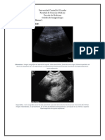 Apendicitis