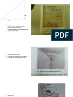 Lateral Spinothalamic Tract: Pain and Temperature - Anterior Spinothalamic Tract: Crude Touch