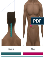 Cervical Piloro