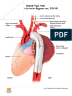 Blood Flow After Carotid Subclavian Bypass and TEVAR: © 2010 The Regents of The University of Michigan