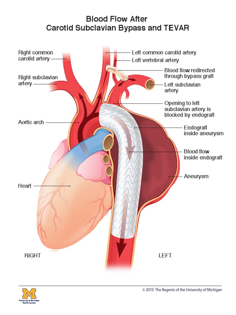 Blood Flow After Carotid Subclavian Bypass and TEVAR: © 2010 The ...