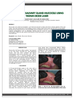 Removal of Salivary Gland Mucocele Using 980Nm Diode Laser: Case Report