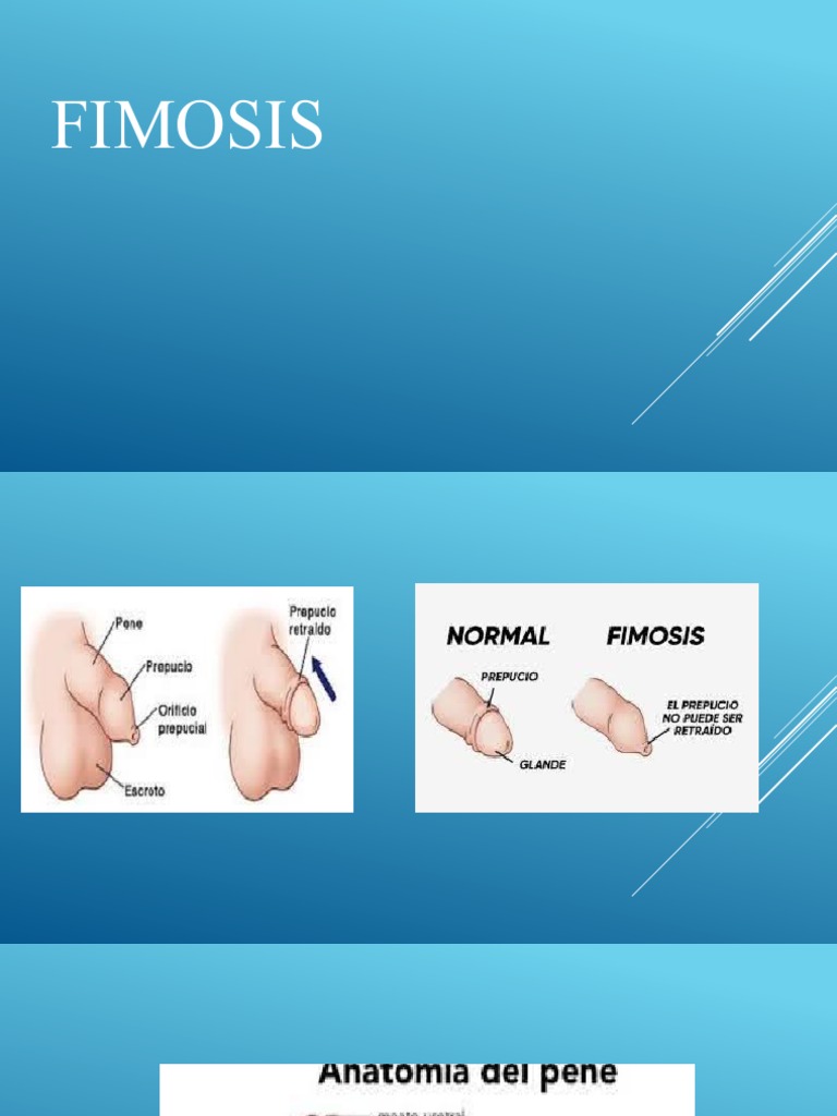 6-fimosis-pdf-circuncisi-n-especialidades-medicas