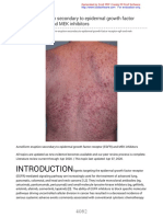 Acneiform eruption secondary to epidermal growth factor receptor (EGFR) and MEK inhibitors