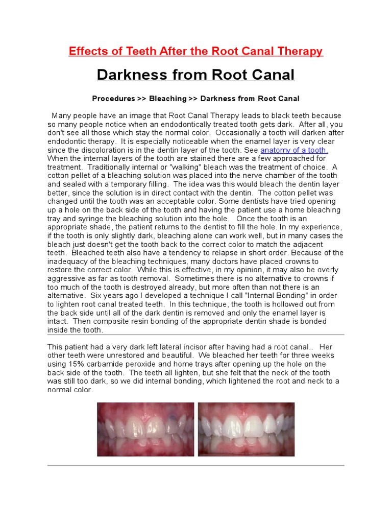 Effects of Teeth After The Root Canal Therapy | PDF | Tooth | Mouth