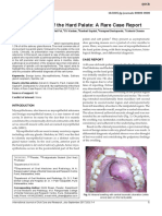 Myoepithelioma of The Hard Palate: A Rare Case Report: 10.5005/jp-Journals-00000-0000
