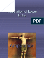 Amputation of Lower Limbs