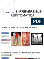 Pulpitis Irreversible