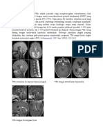 Retinoblastoma