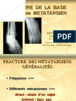 Fracture 5 Metatarsien