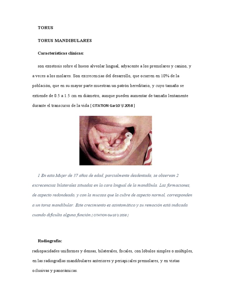 Características del Torus Mandibular y Palatino | PDF | Hueso ...