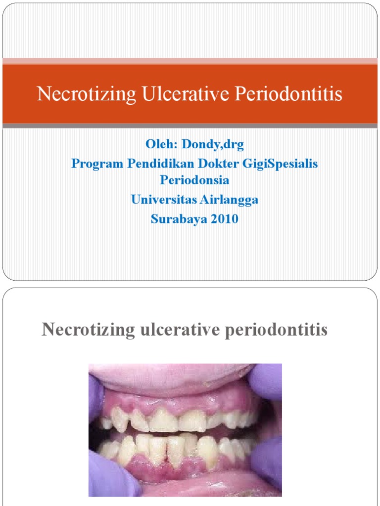 Necrotizing Ulcerative Periodontitis dan NUG | PDF