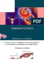 Embarazo Ectopico