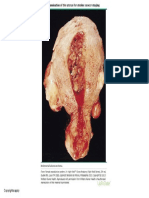 Gross_examination_of_the_uterus_for_uterine_cancer_staging