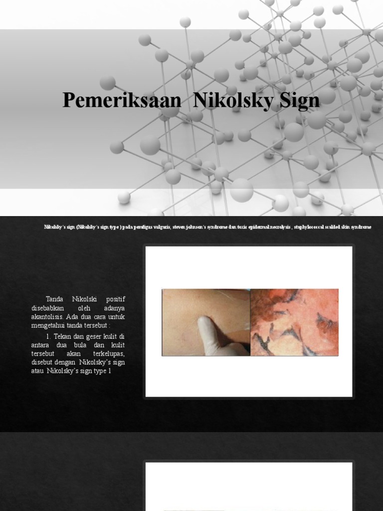 Pemeriksaan Nikolsky Sign Pemeriksaan Nikolsky Sign | PDF