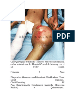 Tumor Musculoesqueletico Osteosarcoma PDF