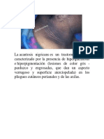 Acantosis Nigricns PDF