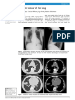 Phantom Tumour of The Lung: Takeshi Saraya, Kosuke Ohkuma, Aya Hirata, Keitaro Nakamoto