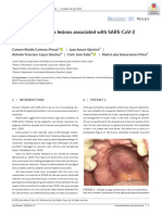 Oral Vesiculobullous Lesions Associated With Sars-Cov-2 Infection