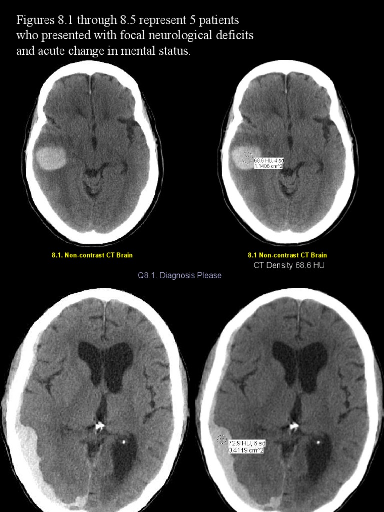 Figures 8.1 Through 8.5 Represent 5 Patients Who Presented With Focal ...