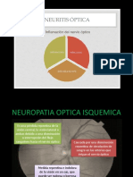 Neuropatía óptica: causas, síntomas y tratamiento