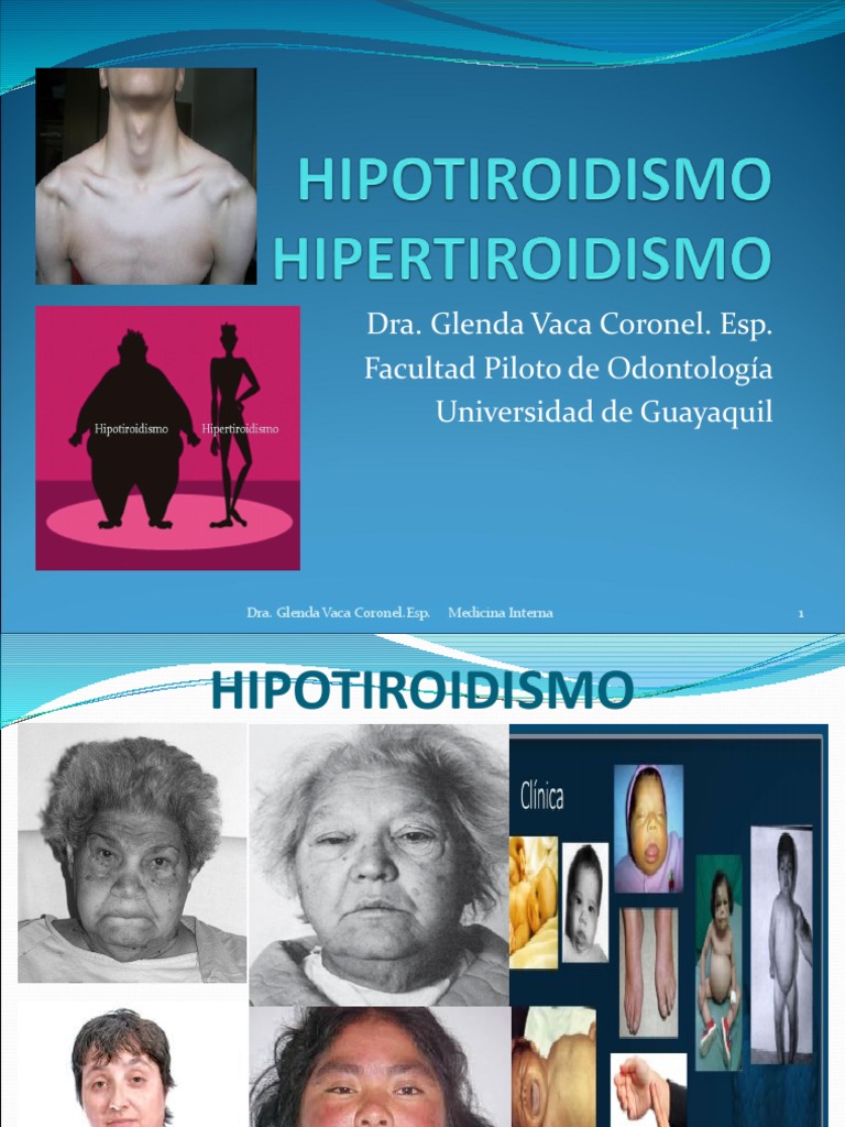 Hipo e Hipertiroidismo PDF Hipertiroidismo Hipotiroidismo