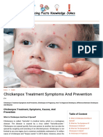 Chickenpox Treatment Symptoms and Prevention