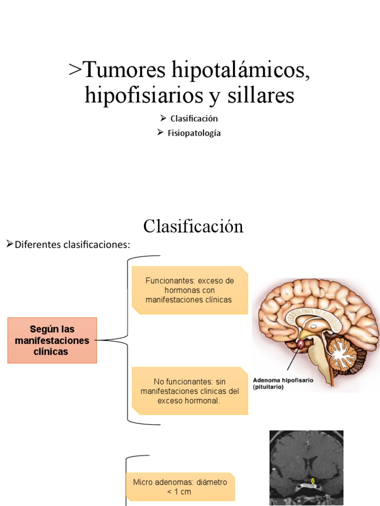 Tumores Hipotalámicos, Hipofisiarios y Sillares | PDF | Transducción de ...