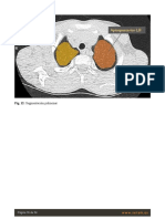 Segmentacion Pulmonar TC