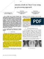 Detection of Pneumonia Clouds in Chest X-Ray Using Image Processing Approach