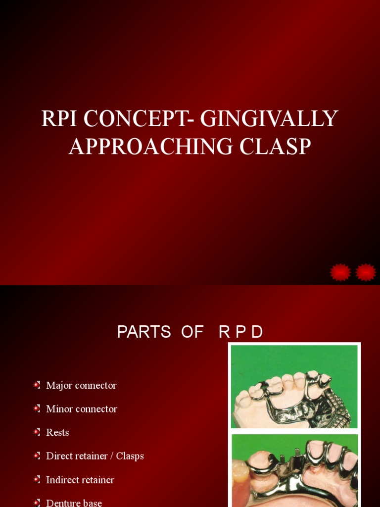 Gingivally Approaching Clasp Pedagogy PDF Mouth Dentistry
