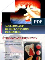 Avulsion and Re Plantation