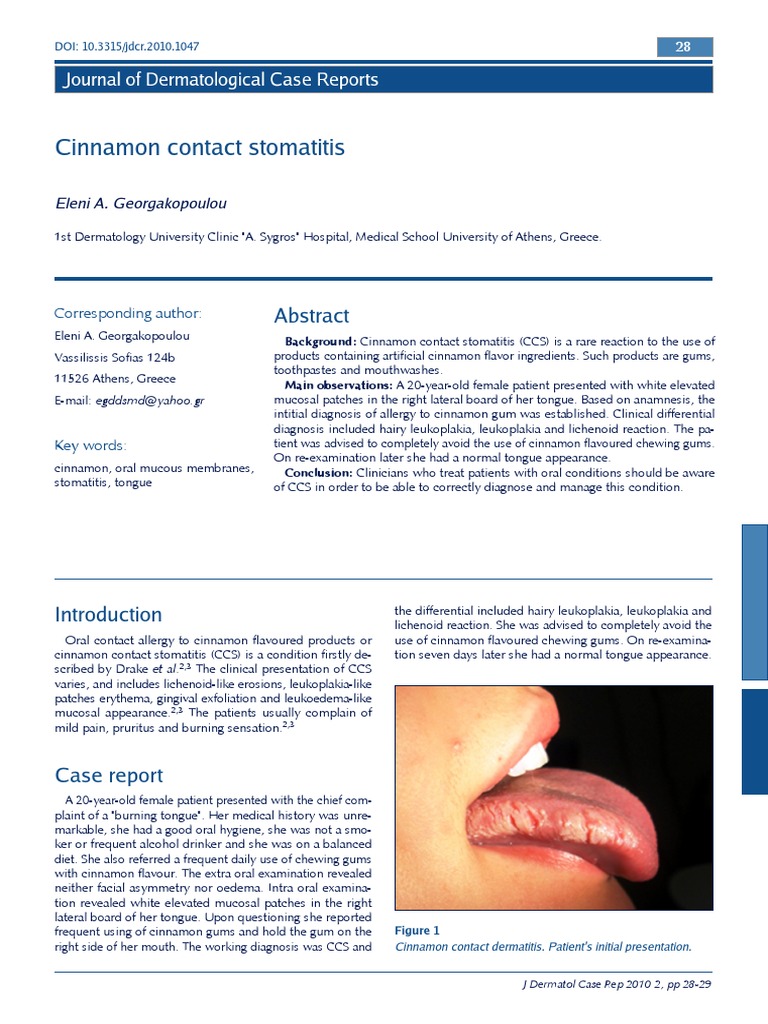 Cinnamon Contact Stomatitis PDF Allergy Epidemiology