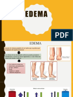 Edema: causas, tipos y tratamiento