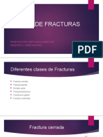 Clases de Fracturas Exposicion Nataila