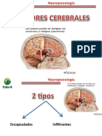 5 Tumores Cerebrales