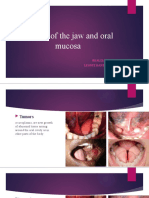 Tumors of The Jaw and Oral Mucosa