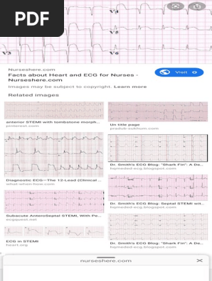 tombstone appearance ecg - Google Search