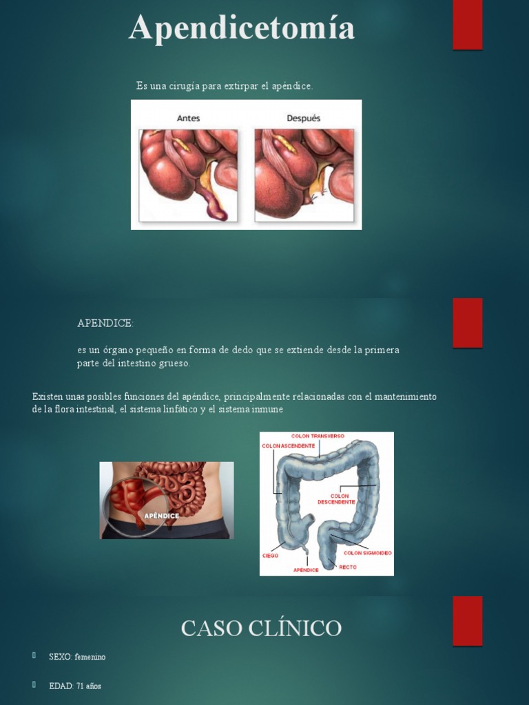 Apendicectomia Final | PDF | Abdomen | Anatomía
