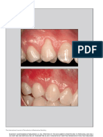 Clinical Considerations On The Root Coverage of Gingival Recessions in Thin or Thick Biotype Kahn2016