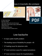 Traumatic Disc Prolapse - Endoscopic Approach