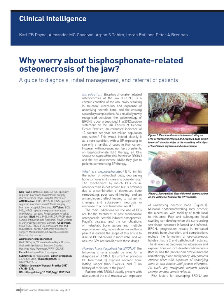 Why Worry About Bisphosphonate-Related Osteonecrosis of The Jaw? | PDF ...