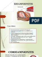 Corioamnionitis: Causas, Diagnóstico y Tratamiento