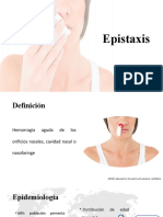 Epistaxis